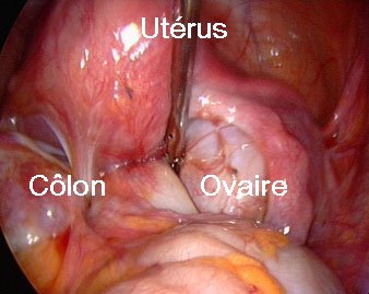 Fig 6: L'endométriose ovarienne est responsable de la formation de kystes ovariens dits "kystes chocolat". Ces kystes provoquent aussi la stérilité et doivent faire l'objet d'un traitement par une équipe spécialisée pour éviter que l'ovaire ne soit endommagé.