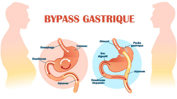 schema-bypass-gastrique