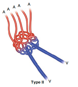 malformation-arterio-veineuse