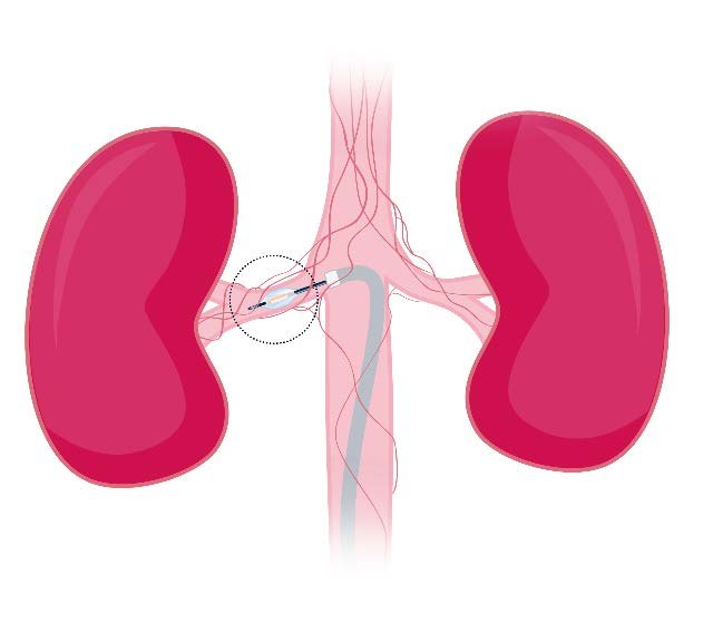 Illustration de la dénervation rénale