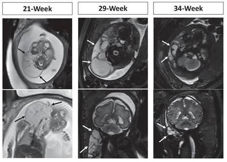 Image de la malformation in utero