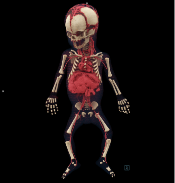 angiographie