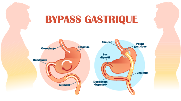 Le bypass gastrique