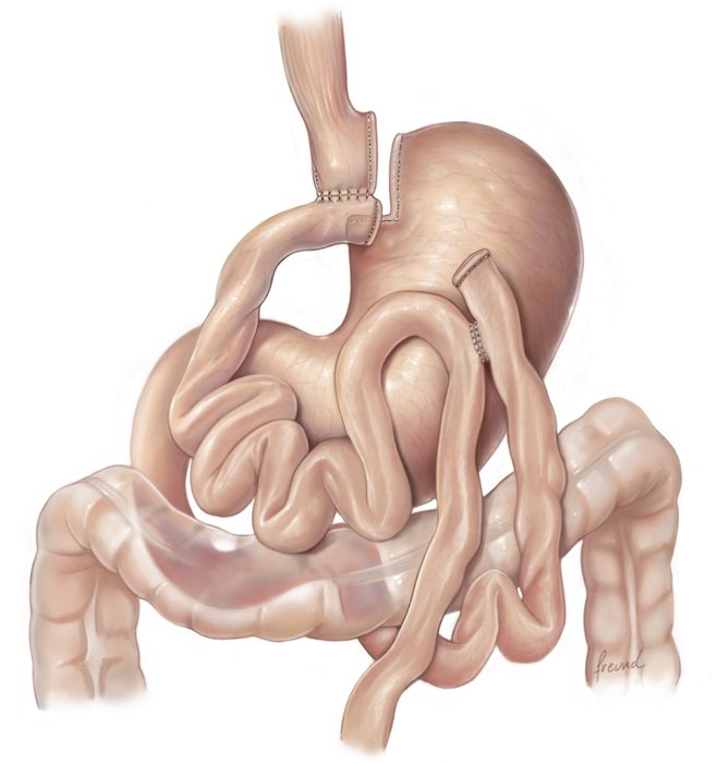 By pass gastrique-Copy B. Navez