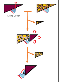 Illustration du greffon partiel