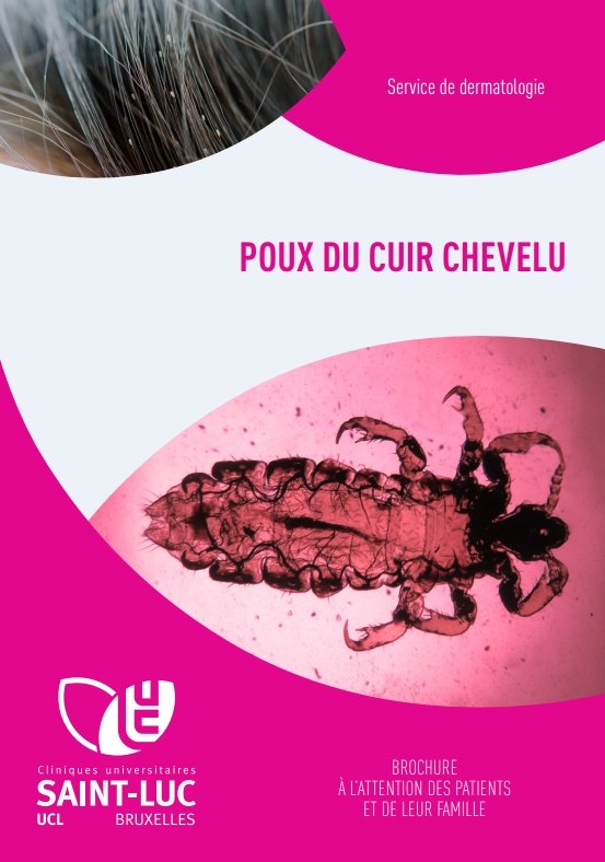 Poux du cuir chevelu