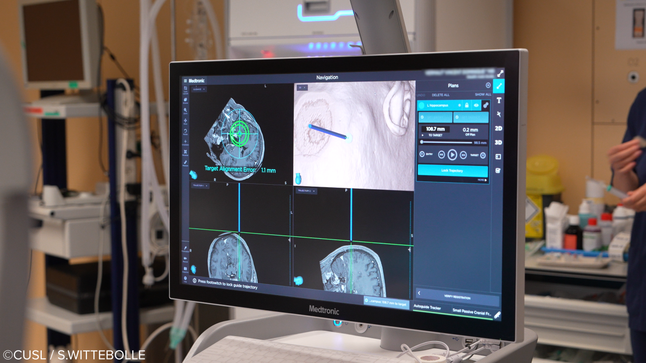Neurochirurgie - opération d'épilepsie réfractaire