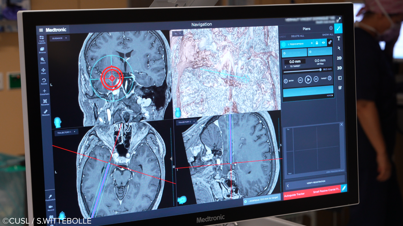 Neurochirurgie - opération d'épilepsie réfractaire