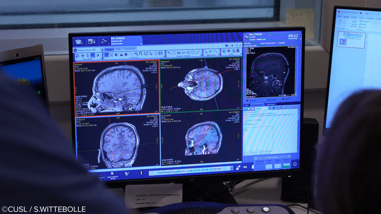 Neurochirurgie - opération d'épilepsie réfractaire