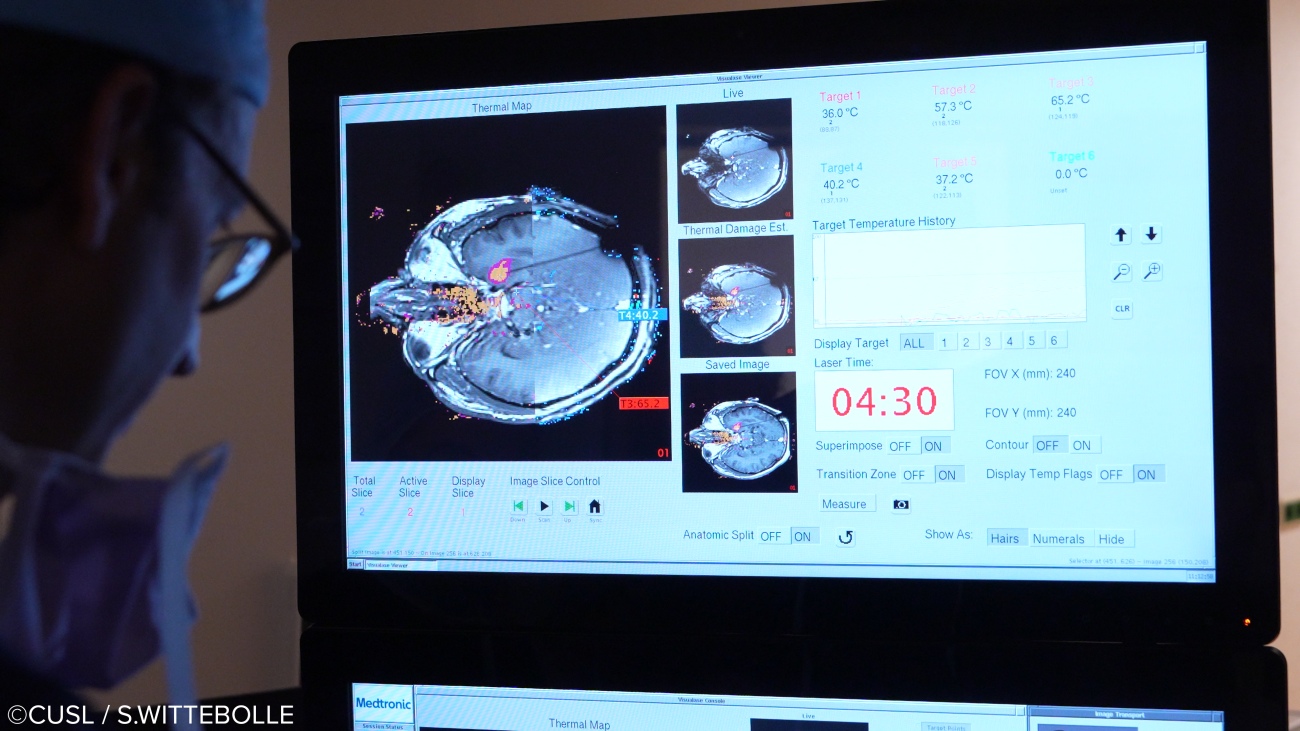 Neurochirurgie - opération d'épilepsie réfractaire