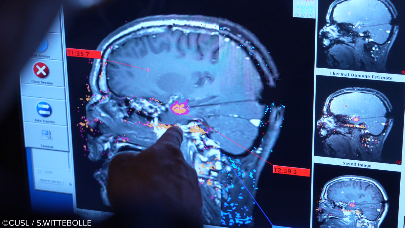 Neurochirurgie - opération d'épilepsie réfractaire