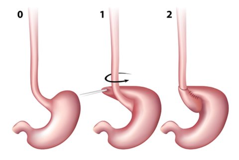 Chirurgie antireflux par fundoplicature selon NISSEN