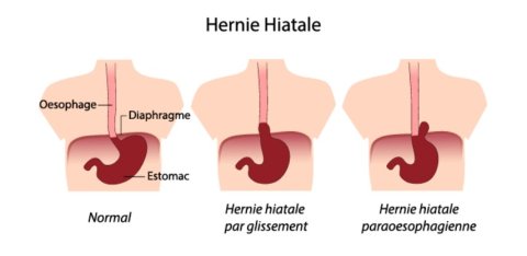 hernie hiatale