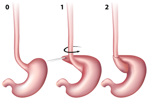 schema-nissen-fundoplicature.png